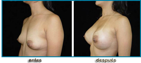 Mamoplastia de Aumento, antes y después